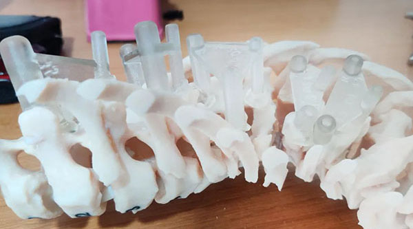 3D打印為脊柱側凸治療提供支持